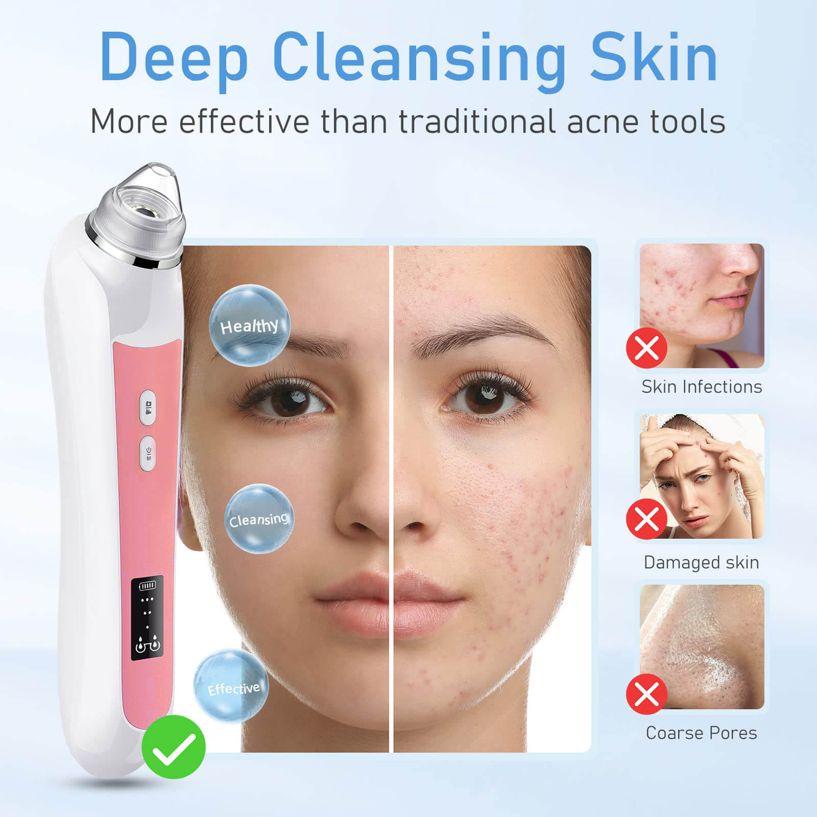 Visual Blackhead Remover Vacuum with HD Camera - Image 3